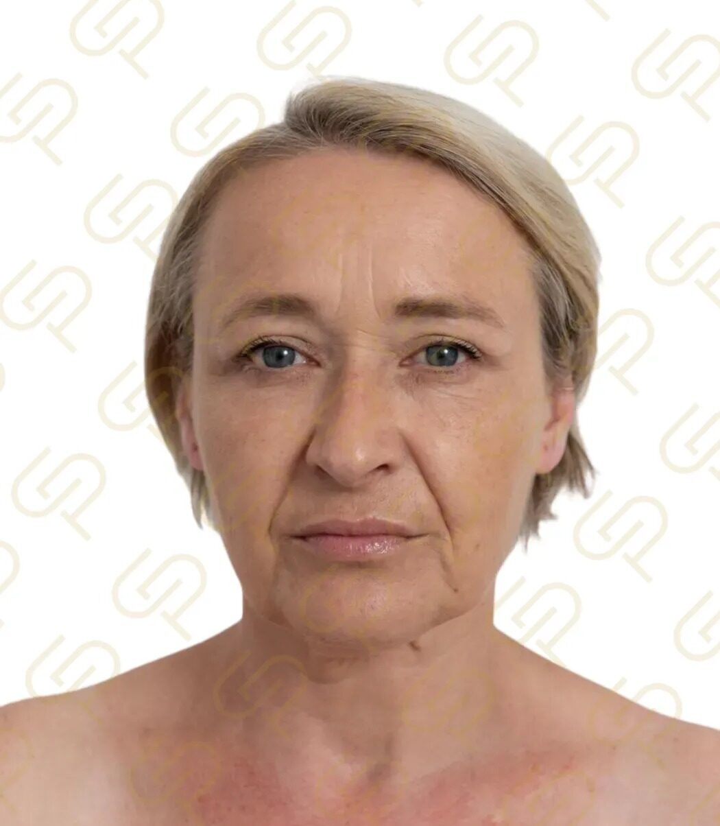 Deep plane facelift a deep necklift - naprosto přirozená proměna